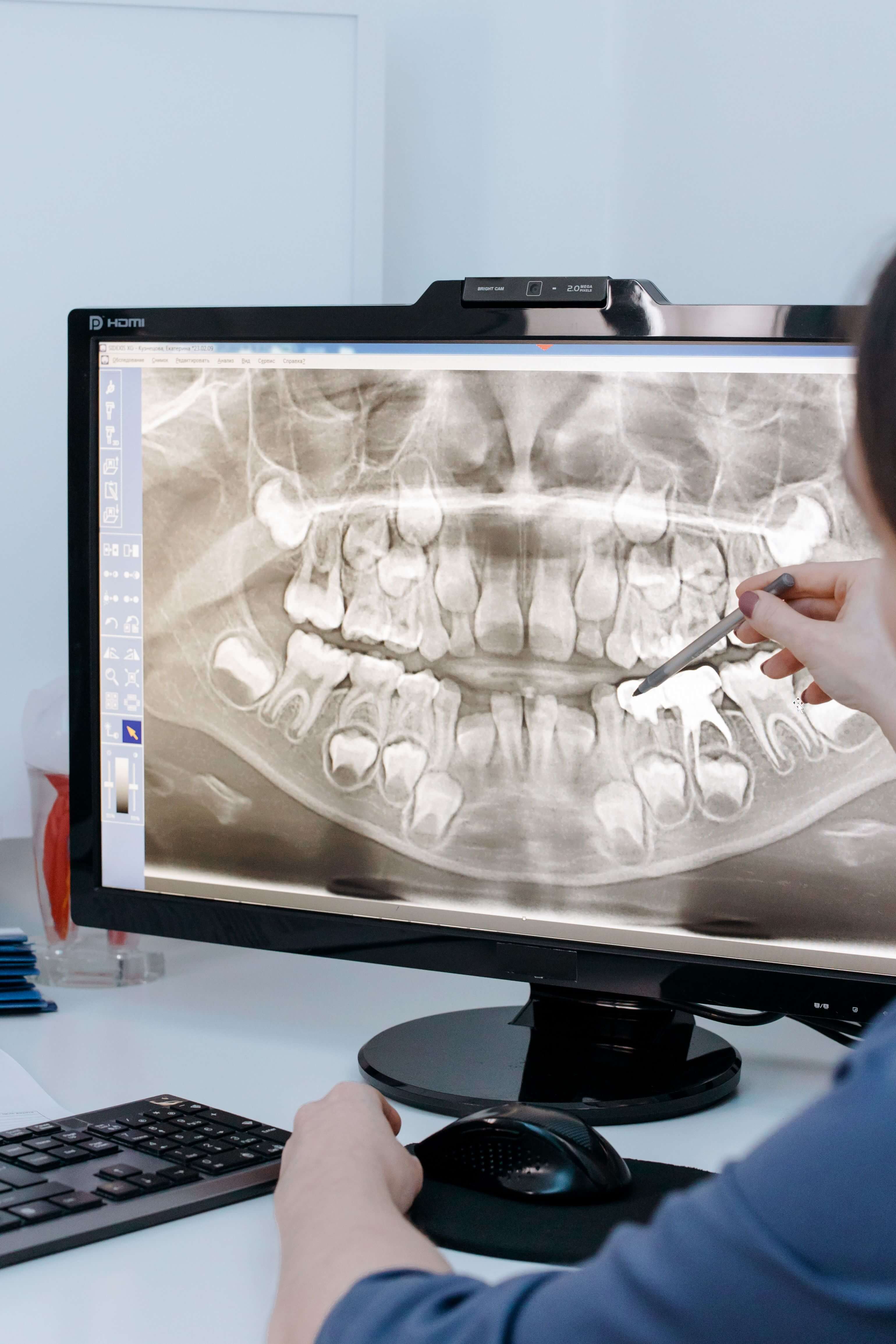 Dental professional reviewing a panoramic digital X-ray for implant planning
